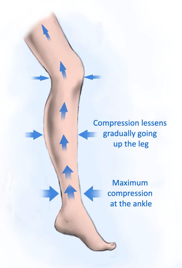 What is Graduated Compression and How Can It Assist You? · Lymph